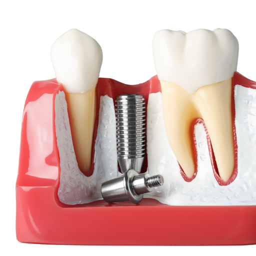 Implante dentario CEMIC